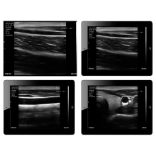 VIATOM lineáris vezeték nélküli orvosi ultrahang 7.5-10 MHz