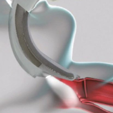 Dahlhausen Video Laryngoscop  - egyszer használatos lapocokkal