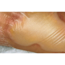 HYDROCOLL CLASSIC THIN 15 X 15 CM