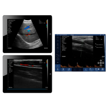 VIATOM lineáris/convex vezeték nélküli orvosi ultrahang 7.5-10 MHz / 3.5-5 MHz
